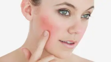 Consejos para cuidar la piel sensible Consejos para cuidar la piel sensible