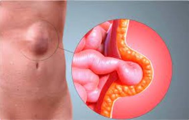 ¿Por qué aparecen las eventraciones o hernia ventral? ¿Por qué aparecen las eventraciones o hernia ventral?