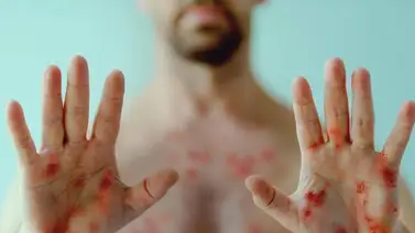 OMS: Brote de viruela del mono se debe a contagio entre personas OMS: Brote de viruela del mono se debe a contagio entre personas