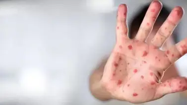 EEUU declara emergencia sanitaria por viruela del mono EEUU declara emergencia sanitaria por viruela del mono