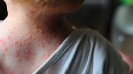 Sao Paulo toma medidas ante casos de viruela del mono
