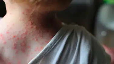 Sao Paulo toma medidas ante casos de viruela del mono Sao Paulo toma medidas ante casos de viruela del mono