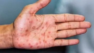 Argentina confirma su primer caso de viruela del mono Argentina confirma su primer caso de viruela del mono