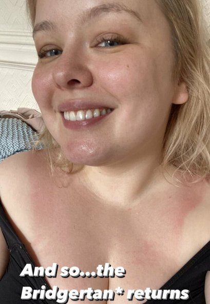 Nicola Coughlan reveló la lesión que sufrió en el set de Bridgerton Nicola Coughlan reveló la lesión que sufrió en el set de Bridgerton