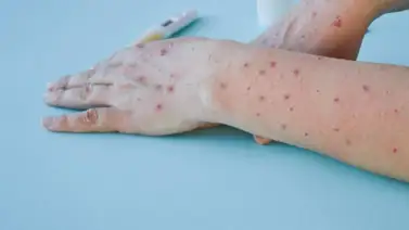 Japón detecta su primer caso de viruela del mono Japón detecta su primer caso de viruela del mono