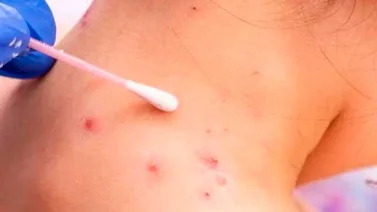 EEUU detecta por primera vez dos casos de viruela del mono en niños