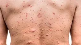 Costa Rica confirma primer caso de viruela del mono