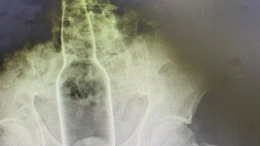 Hombre pasa tres días con una botella en el recto