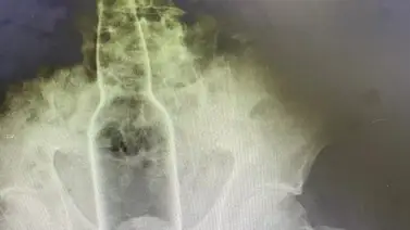 Hombre pasa tres días con una botella en el recto Hombre pasa tres días con una botella en el recto