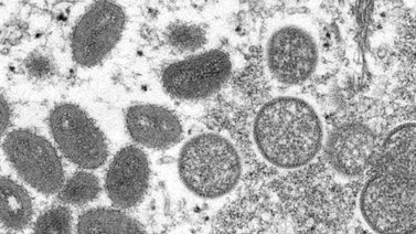 Barbados detecta su primer caso de viruela del mono