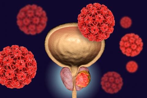 Cáncer de próstata: una prueba oportuna influye en la recuperación Cáncer de próstata: una prueba oportuna influye en la recuperación