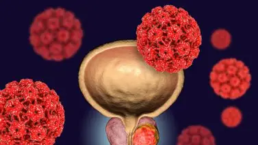Más de tres mil muertes anuales produce el cáncer de próstata Más de tres mil muertes anuales produce el cáncer de próstata
