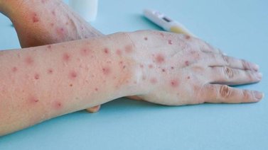 OMS: casos de viruela del mono aumentan un 77% en el mundo