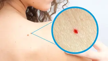 ¿Por qué salen los puntos rojos en la piel? ¿Por qué salen los puntos rojos en la piel?