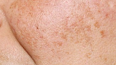 No dejes que las manchas en la piel te incomoden