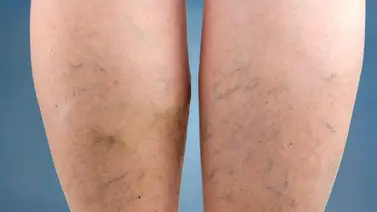 Elimina las várices de forma natural Elimina las várices de forma natural