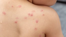 México confirma cinco casos de viruela del mono