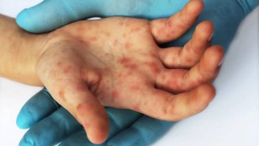EMA: la viruela del mono no es “una emergencia de salud pública”