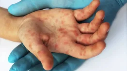 EMA: la viruela del mono no es “una emergencia de salud pública”