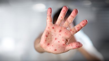 OMS: se debe luchar contra "el estigma" vinculado a la viruela del mono