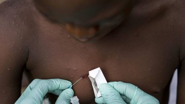 Registran 1.400 casos de viruela del mono en siete países de África
