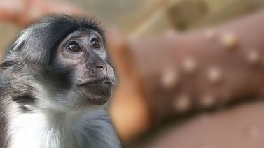 Costa Rica sigue en alerta por eventual aparición de viruela del mono