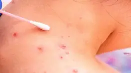 Antivirales pueden reducir duración de los síntomas de viruela del mono, según estudio