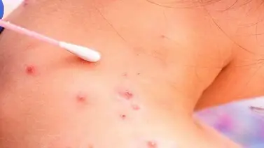 Antivirales pueden reducir duración de los síntomas de viruela del mono, según estudio Antivirales pueden reducir duración de los síntomas de viruela del mono, según estudio