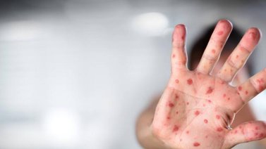 ¡Alerta sanitaria! España detecta 7 casos por viruela del mono