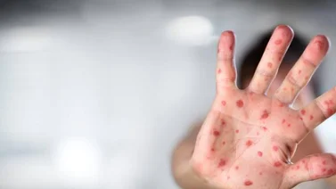 ¡Alerta sanitaria! España detecta 7 casos por viruela del mono