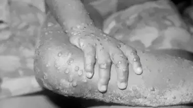 Se registran dos casos de viruela en el Reino Unido Se registran dos casos de viruela en el Reino Unido