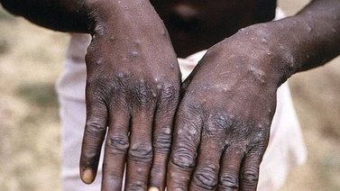 Al menos nueve personas contagiadas de viruela del mono
