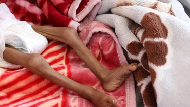 ONG: 350.000 niños pueden morir de desnutrición en África