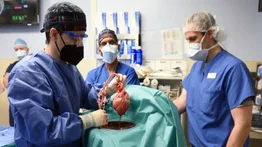 Encuentran virus en corazón de cerdo trasplantado a hombre