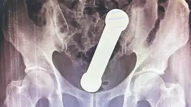 Hombre brasileño introduce una pesa en su recto por “placer sexual” Hombre brasileño introduce una pesa en su recto por “placer sexual”