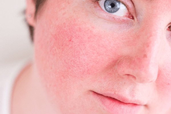 Rosácea: causas, síntomas y tratamiento Rosácea: causas, síntomas y tratamiento
