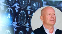 Especialista: Enfermedad de Bruce Willis es un tipo de demencia