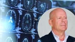 Especialista: Enfermedad de Bruce Willis es un tipo de demencia
