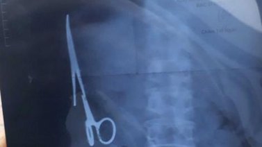 Le dejan una tijera en el estómago tras operación quirúrgica