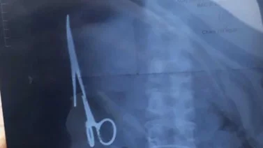 Le dejan una tijera en el estómago tras operación quirúrgica
