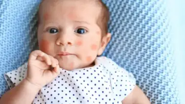 Reconoce si tu bebé sufre de alergias Reconoce si tu bebé sufre de alergias