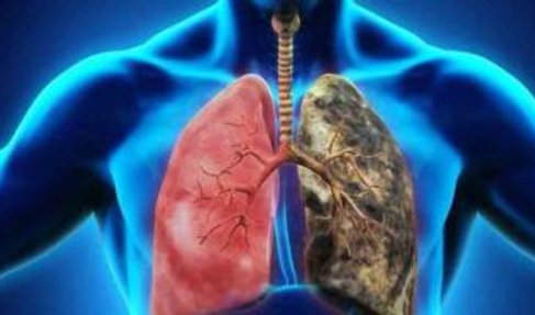 Diferencias entre la bronquitis aguda y la neumonía Diferencias entre la bronquitis aguda y la neumonía