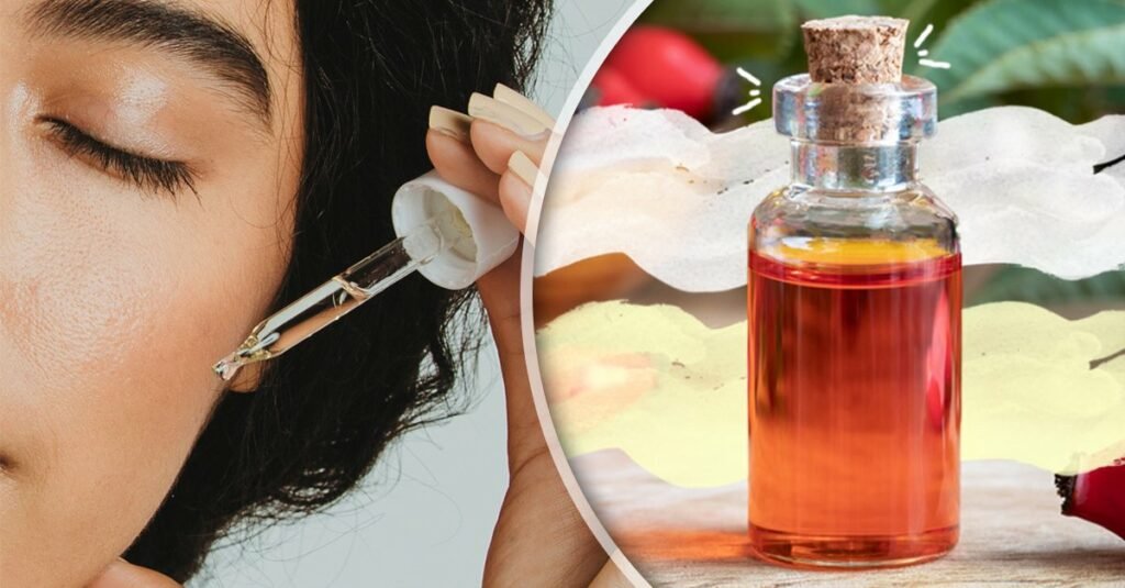 Usa aceite de rosa mosqueta para controlar el acné Usa aceite de rosa mosqueta para controlar el acné