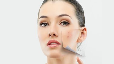 ¿Cómo tratar las secuelas del acné?