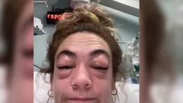 Tiktoker termina en el hospital luego de tener una reacción alérgica a las extensiones de pestañas
