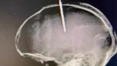 Un hombre se incrusta un clavo en la cabeza porque sentía su “cerebro flojo” Un hombre se incrusta un clavo en la cabeza porque sentía su “cerebro flojo”