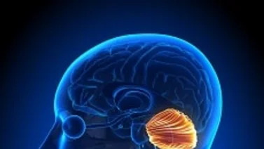 Síndrome Arnold Chiari: malformación congénita del sistema nervioso