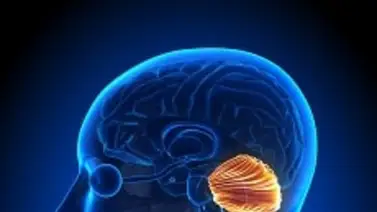 Síndrome Arnold Chiari: malformación congénita del sistema nervioso Síndrome Arnold Chiari: malformación congénita del sistema nervioso