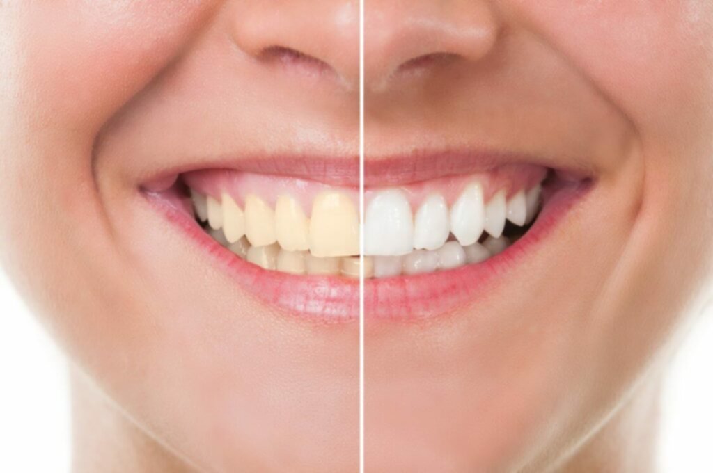 Tipos de blanqueamiento dental Tipos de blanqueamiento dental