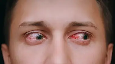 Cuida la vista de la conjuntivitis Cuida la vista de la conjuntivitis